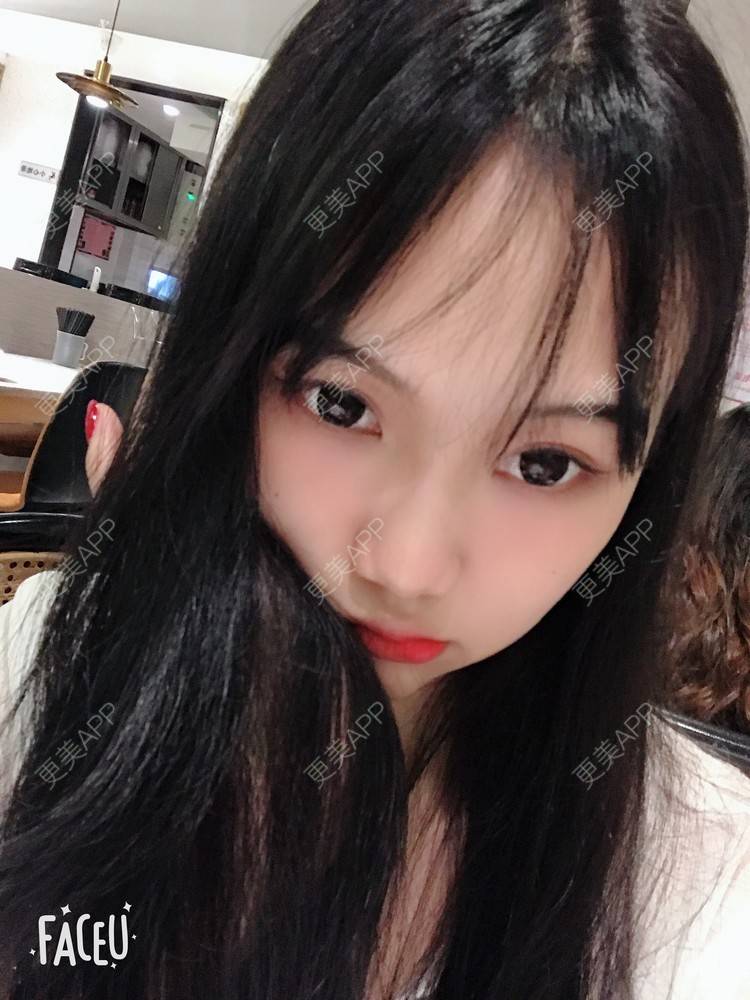 更美 - 更美用户IHPVyjEmt4的双眼皮经验 | 双眼皮 | 深圳