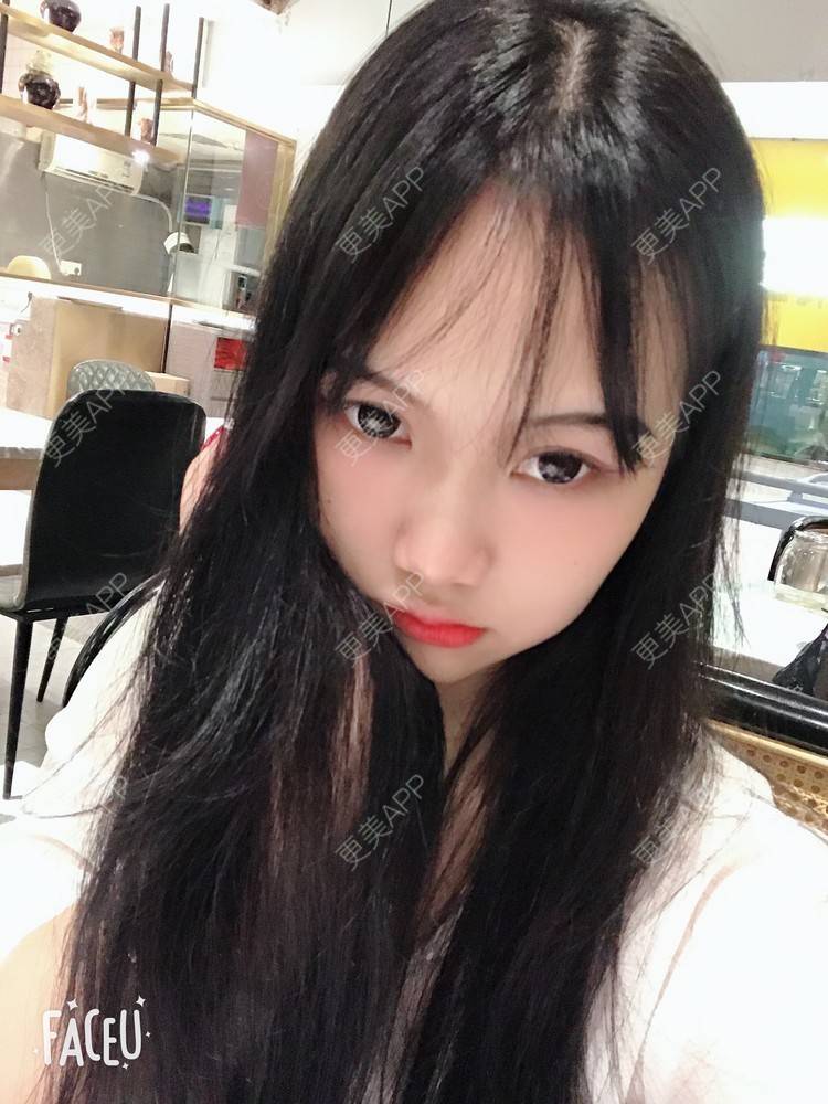 更美 - 更美用户IHPVyjEmt4的双眼皮经验 | 双眼皮 | 深圳