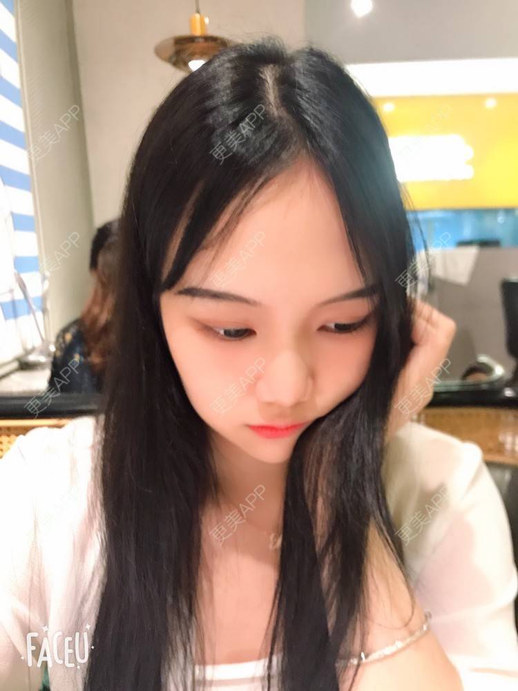 更美 - 更美用户IHPVyjEmt4的双眼皮经验 | 双眼皮 | 深圳