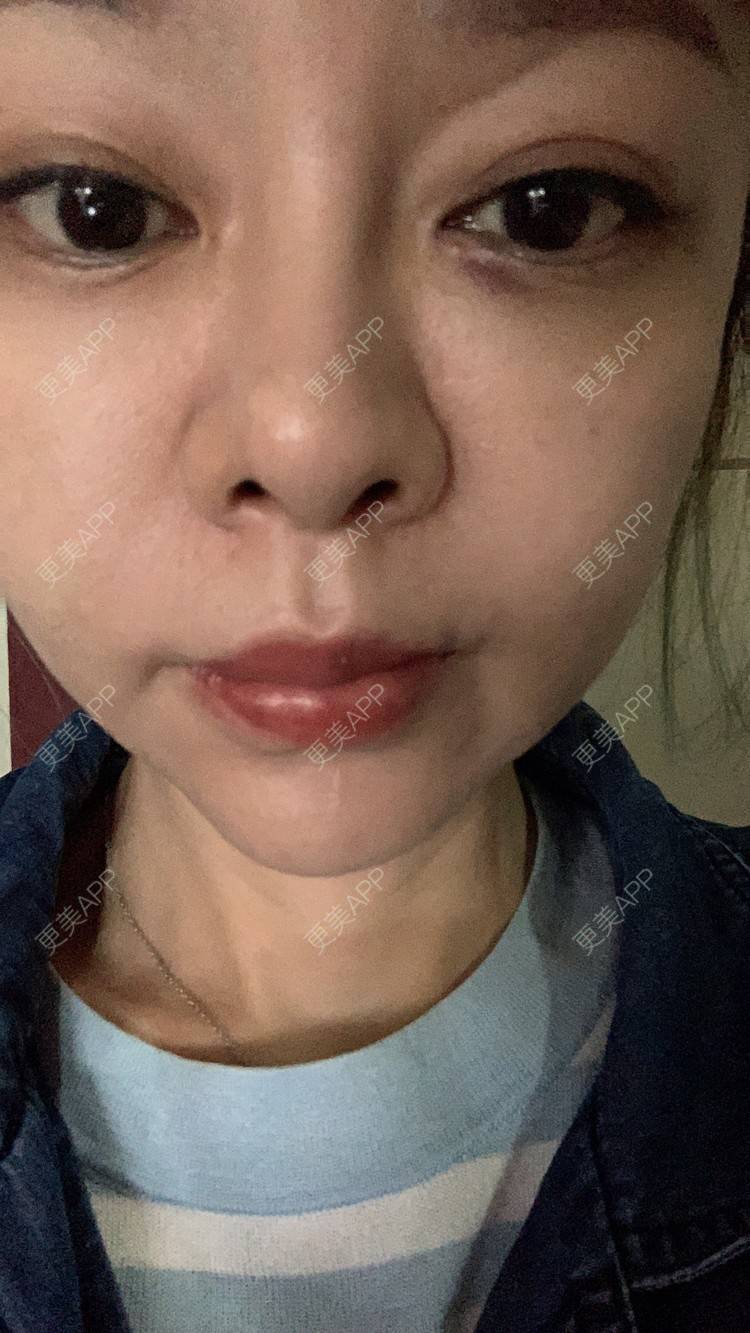 更美 - 衣衣丫丫的埋线提升经验 | 埋线提升 | 重庆