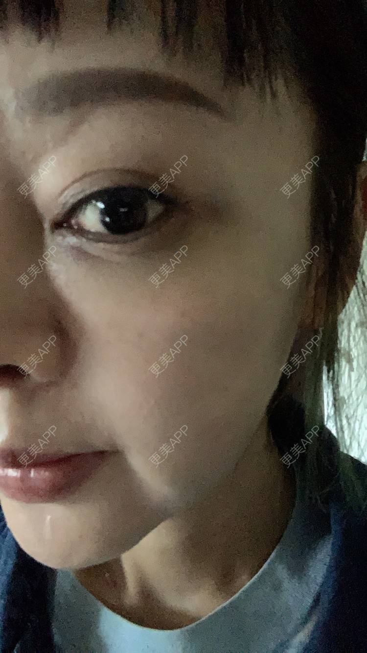 更美 - 衣衣丫丫的埋线提升经验 | 埋线提升 | 重庆