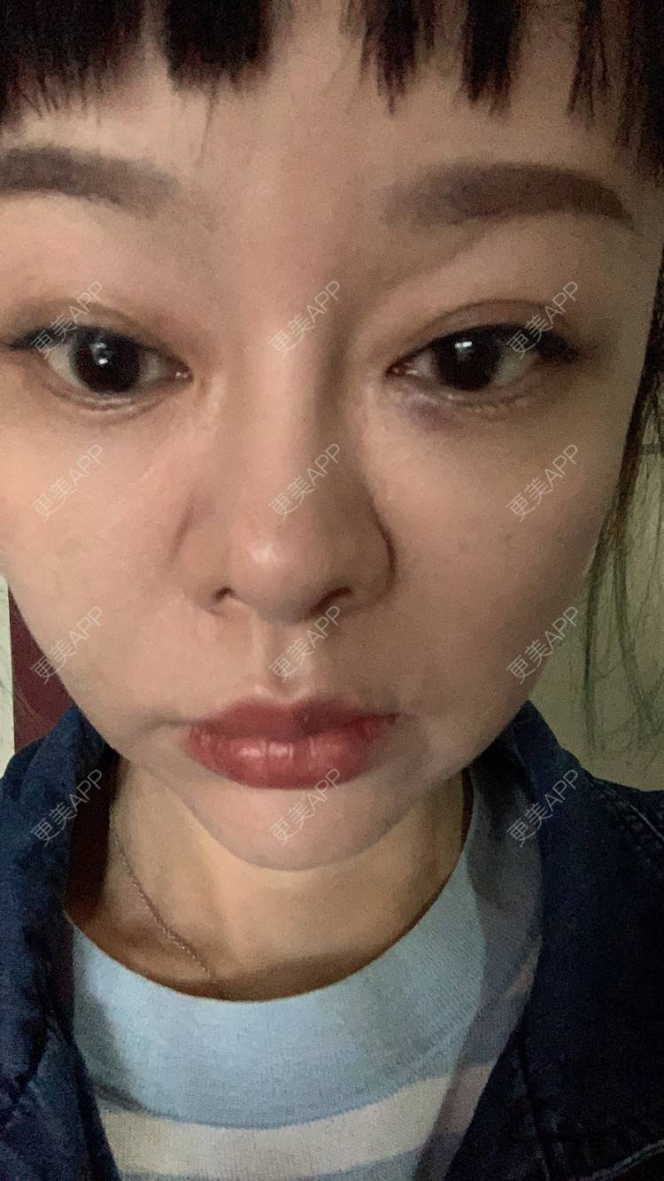 更美 - 衣衣丫丫的埋线提升经验 | 埋线提升 | 重庆
