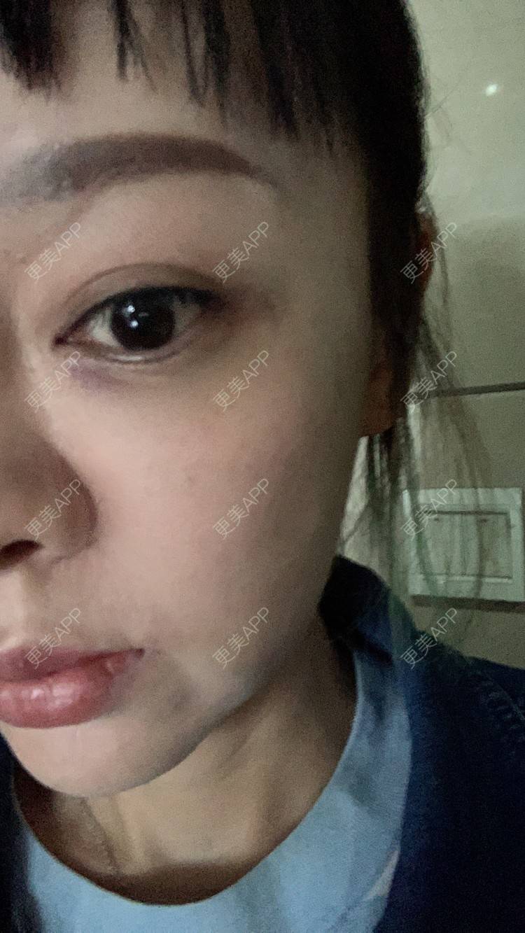 更美 - 衣衣丫丫的埋线提升经验 | 埋线提升 | 重庆