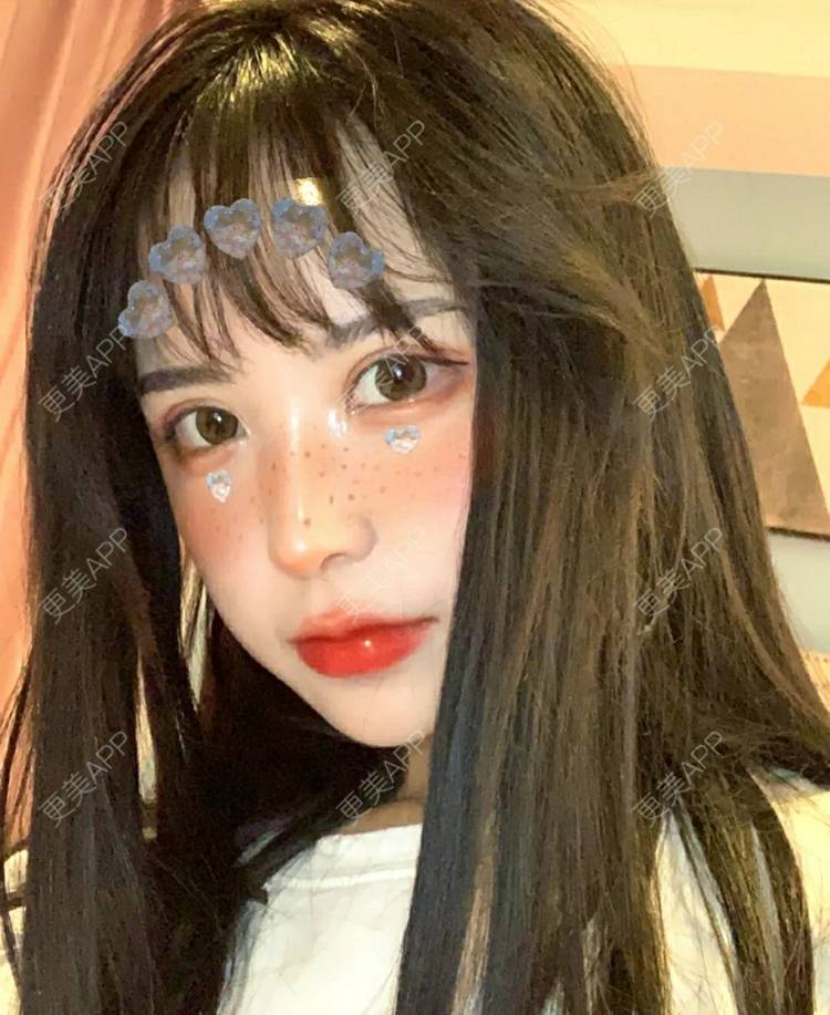 更美 - 更美用户OfX8obHDDF的双眼皮经验 | 双眼皮修复 | 更美研究所 | 双眼皮 | 上海