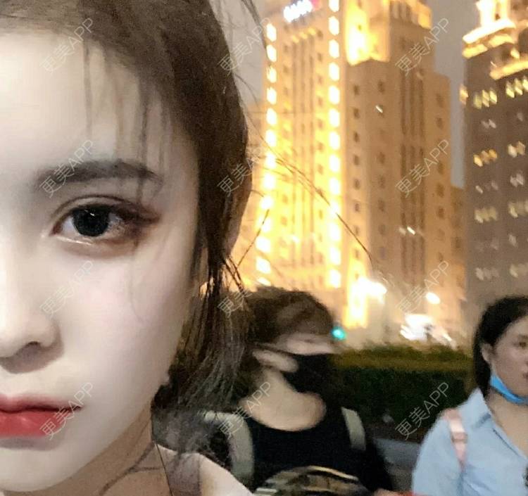更美 - 更美用户OfX8obHDDF的双眼皮经验 | 双眼皮修复 | 更美研究所 | 双眼皮 | 上海