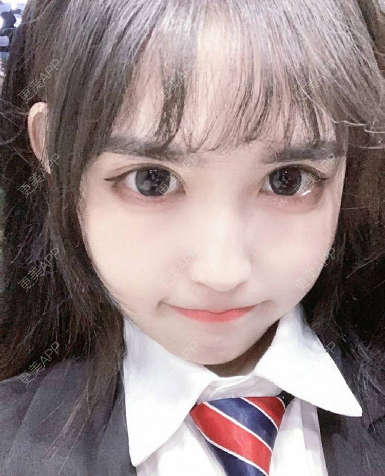 更美 - 更美用户OfX8obHDDF的双眼皮经验 | 双眼皮修复 | 更美研究所 | 双眼皮 | 上海