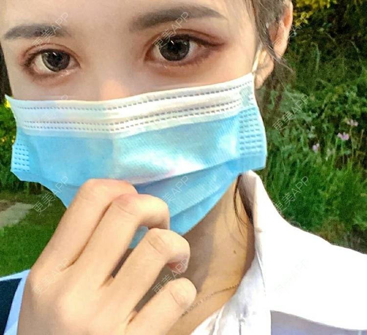 更美 - 更美用户OfX8obHDDF的双眼皮经验 | 双眼皮修复 | 更美研究所 | 双眼皮 | 上海