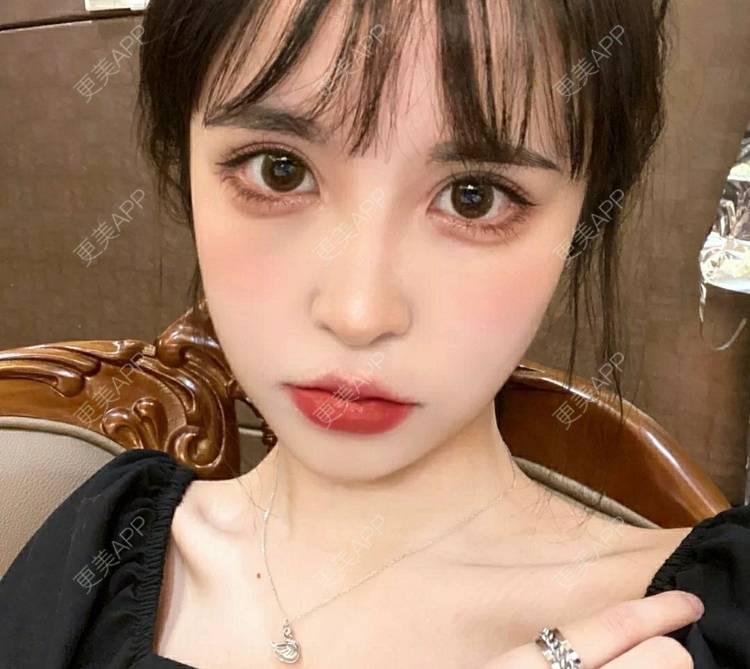 更美 - 更美用户OfX8obHDDF的双眼皮经验 | 双眼皮修复 | 更美研究所 | 双眼皮 | 上海