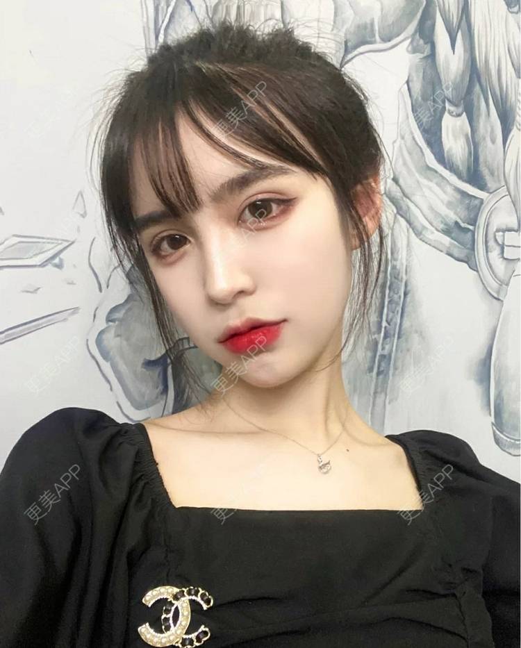 更美 - 更美用户OfX8obHDDF的双眼皮经验 | 双眼皮修复 | 更美研究所 | 双眼皮 | 上海