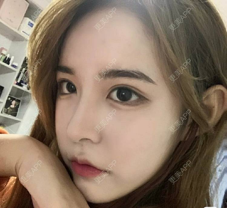 更美 - 更美用户OfX8obHDDF的双眼皮经验 | 双眼皮修复 | 更美研究所 | 双眼皮 | 上海