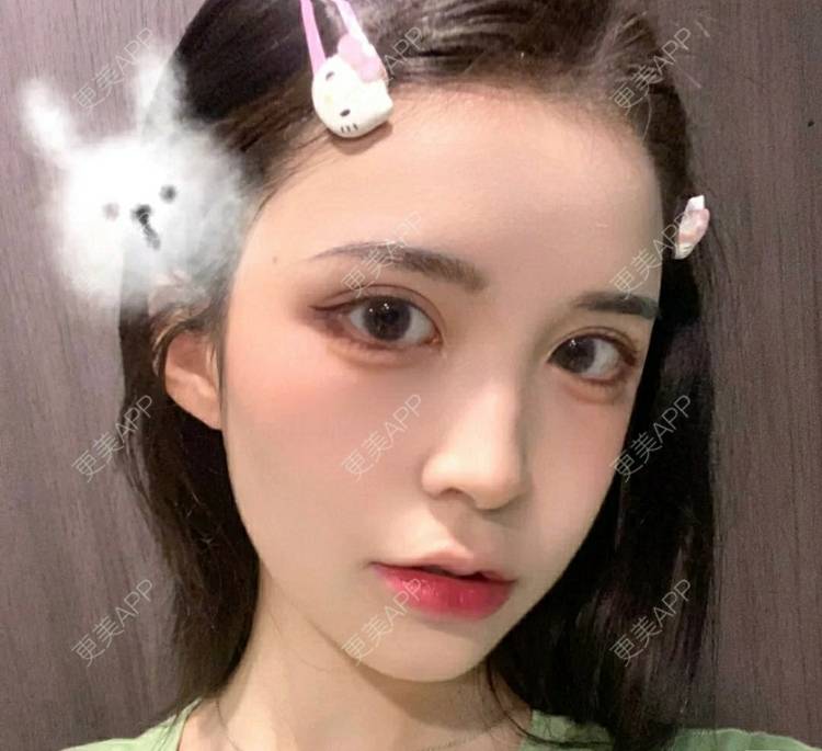 更美 - 更美用户OfX8obHDDF的双眼皮经验 | 双眼皮修复 | 更美研究所 | 双眼皮 | 上海