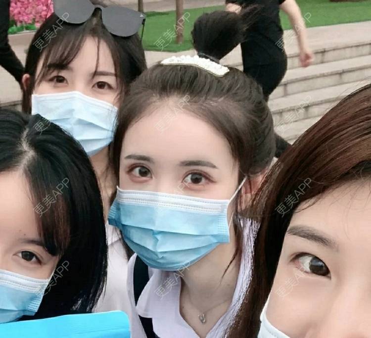 更美 - 更美用户OfX8obHDDF的双眼皮经验 | 双眼皮修复 | 更美研究所 | 双眼皮 | 上海