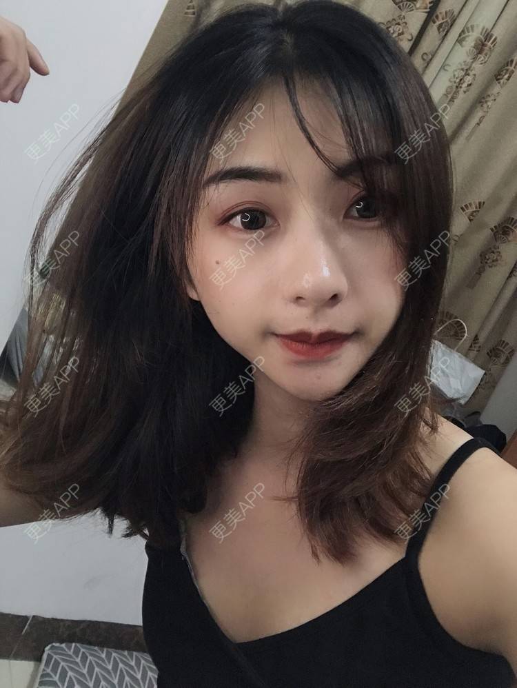 更美 - 更美用户h6811W70iO的鼻翼缩小经验 | 鼻翼缩小 | 福州 | 人工骨隆鼻 | 真皮隆鼻 | 长鼻矫正 | 微晶瓷隆鼻