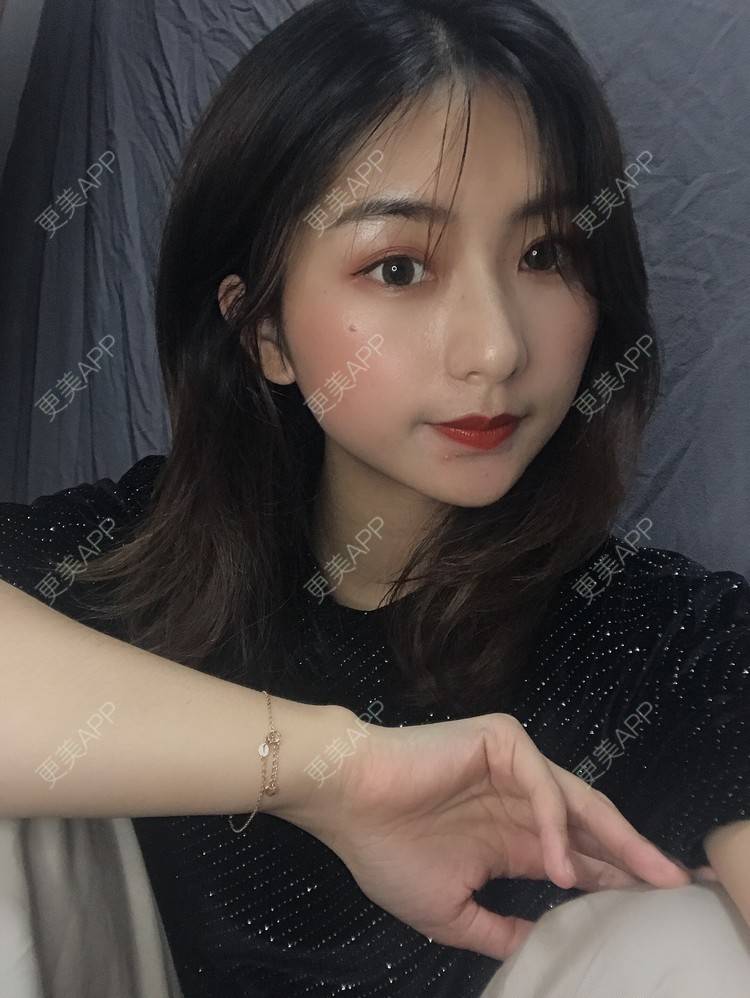 更美 - 更美用户h6811W70iO的鼻翼缩小经验 | 鼻翼缩小 | 福州 | 人工骨隆鼻 | 真皮隆鼻 | 长鼻矫正 | 微晶瓷隆鼻
