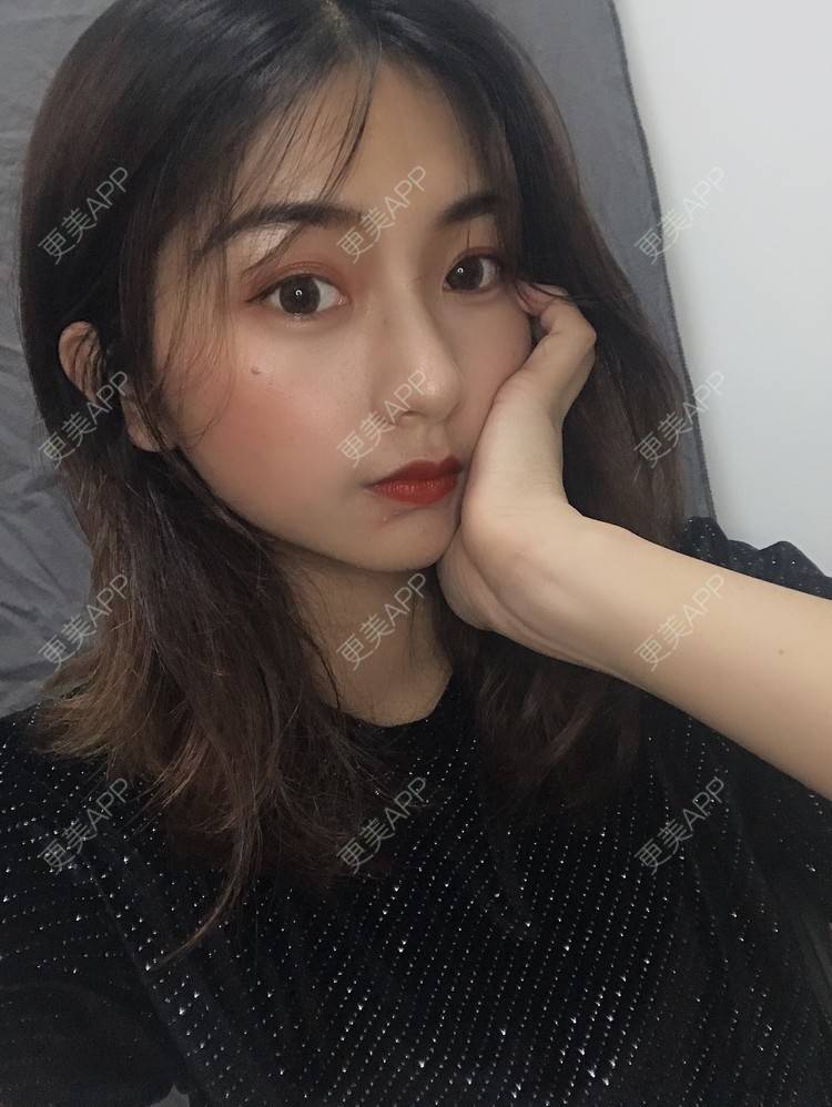 更美 - 更美用户h6811W70iO的鼻翼缩小经验 | 鼻翼缩小 | 福州 | 人工骨隆鼻 | 真皮隆鼻 | 长鼻矫正 | 微晶瓷隆鼻