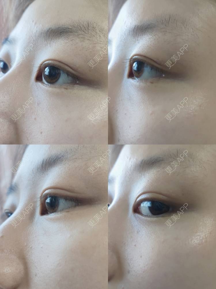 viccy的上眼睑去脂日记