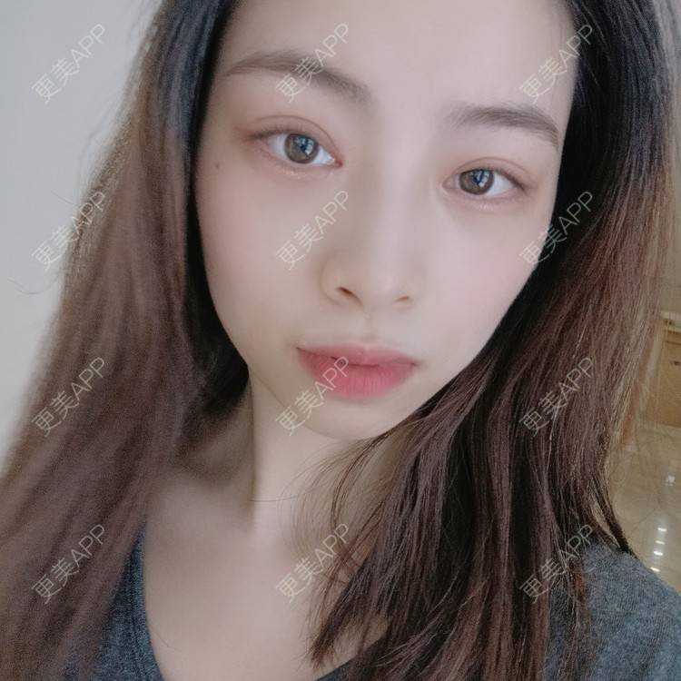 更美 - 蔓蔓青萝-的双眼皮经验 | 双眼皮 | 全切双眼皮 | 开内眼角 | 内切去眼袋 | 重庆