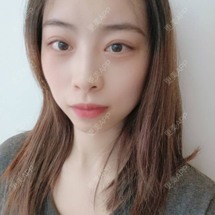更美 - 蔓蔓青萝-的双眼皮经验 | 双眼皮 | 全切双眼皮 | 开内眼角 | 内切去眼袋 | 重庆