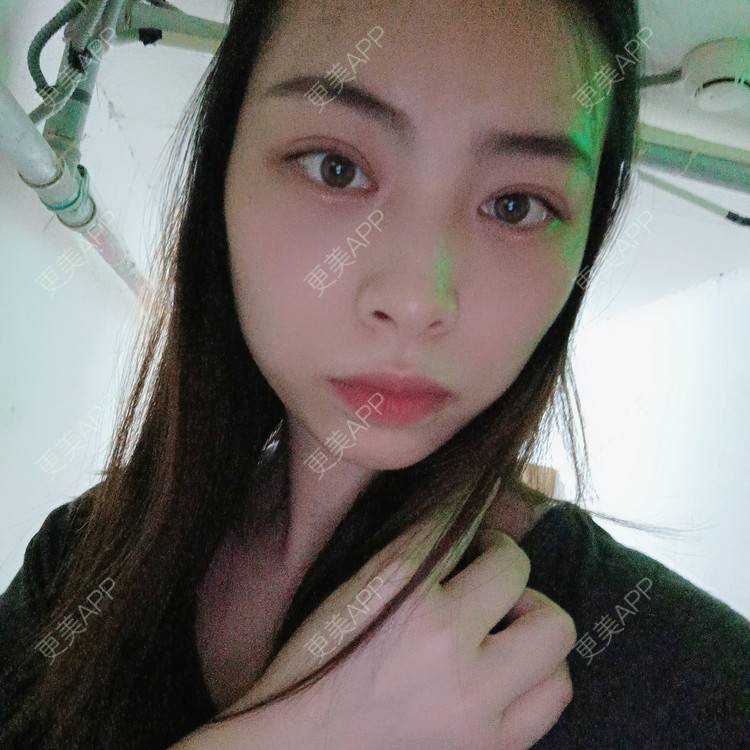 更美 - 蔓蔓青萝-的双眼皮经验 | 双眼皮 | 全切双眼皮 | 开内眼角 | 内切去眼袋 | 重庆