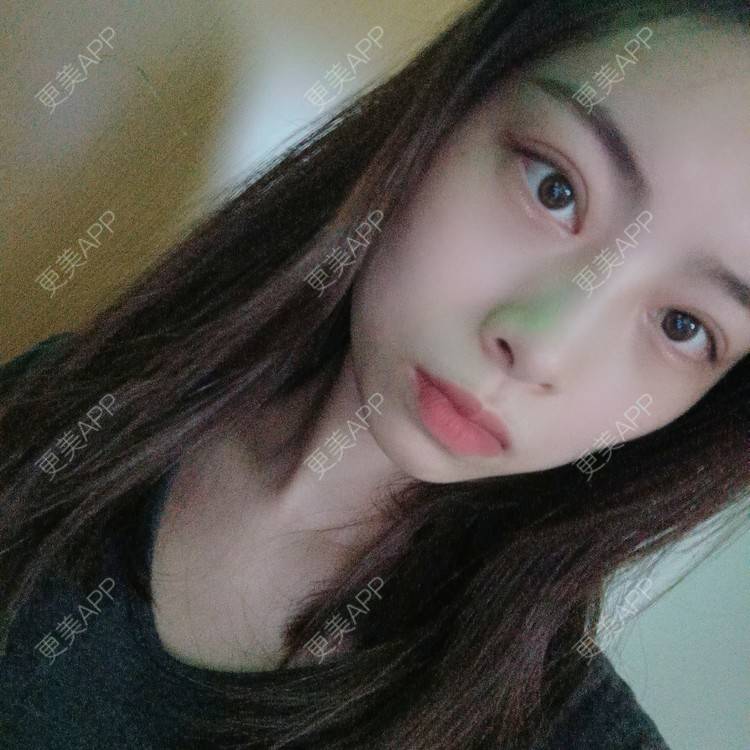 更美 - 蔓蔓青萝-的双眼皮经验 | 双眼皮 | 全切双眼皮 | 开内眼角 | 内切去眼袋 | 重庆