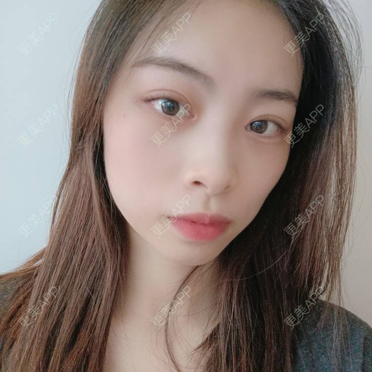 更美 - 蔓蔓青萝-的双眼皮经验 | 双眼皮 | 全切双眼皮 | 开内眼角 | 内切去眼袋 | 重庆