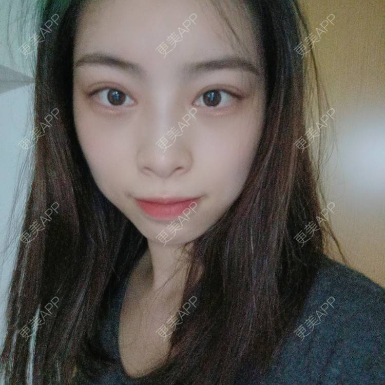 更美 - 蔓蔓青萝-的双眼皮经验 | 双眼皮 | 全切双眼皮 | 开内眼角 | 内切去眼袋 | 重庆