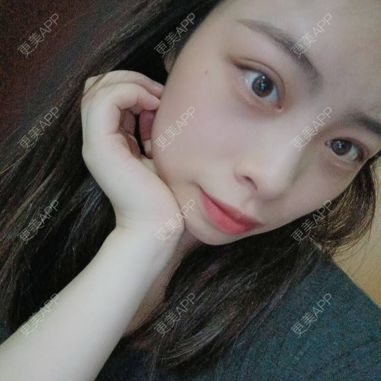 更美 - 蔓蔓青萝-的双眼皮经验 | 双眼皮 | 全切双眼皮 | 开内眼角 | 内切去眼袋 | 重庆