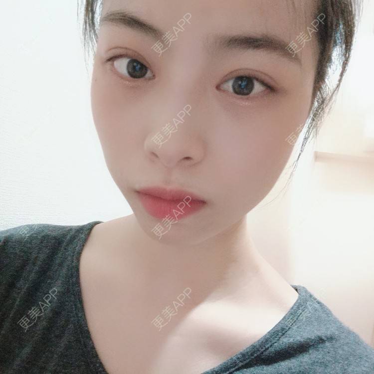 更美 - 蔓蔓青萝-的双眼皮经验 | 双眼皮 | 全切双眼皮 | 开内眼角 | 内切去眼袋 | 重庆