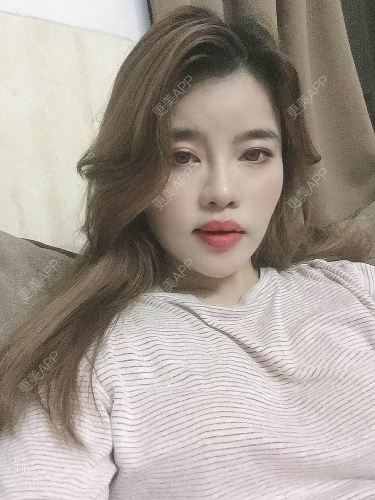 更美 - Edith 、Z的自体脂肪丰苹果肌经验 | 自体脂肪丰额头 | 自体脂肪丰面颊 | 自体脂肪丰太阳穴 | 自体脂肪丰苹果肌 | 福州 | 自体脂肪全面部填充