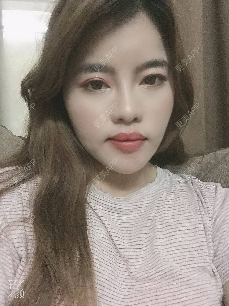 更美 - Edith 、Z的自体脂肪丰苹果肌经验 | 自体脂肪丰额头 | 自体脂肪丰面颊 | 自体脂肪丰太阳穴 | 自体脂肪丰苹果肌 | 福州 | 自体脂肪全面部填充