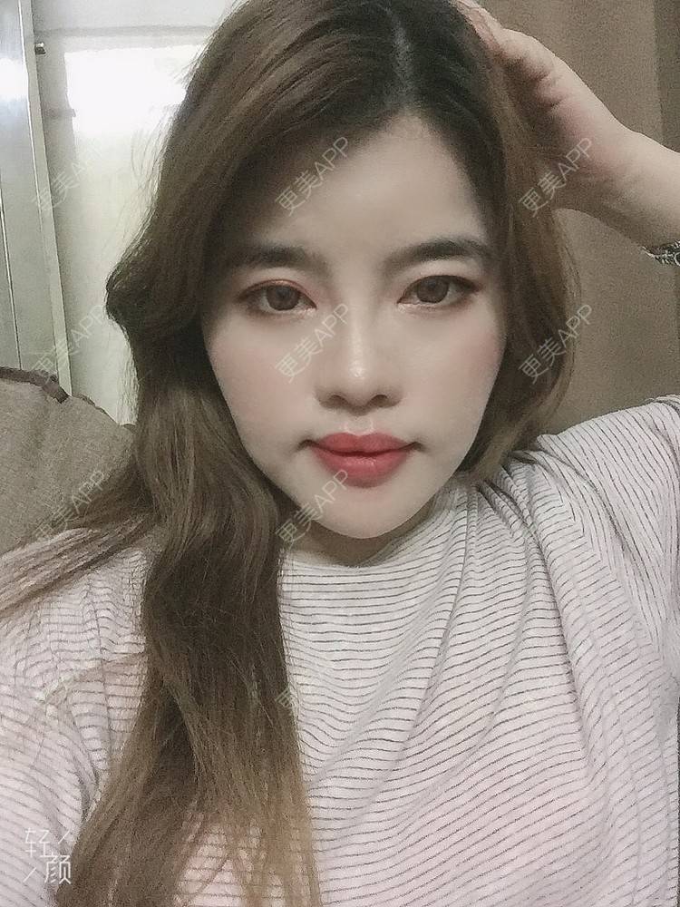 更美 - Edith 、Z的自体脂肪丰苹果肌经验 | 自体脂肪丰额头 | 自体脂肪丰面颊 | 自体脂肪丰太阳穴 | 自体脂肪丰苹果肌 | 福州 | 自体脂肪全面部填充