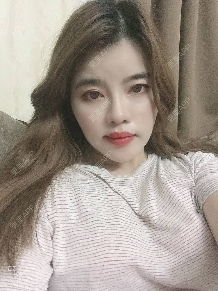 更美 - Edith 、Z的自体脂肪丰苹果肌经验 | 自体脂肪丰额头 | 自体脂肪丰面颊 | 自体脂肪丰太阳穴 | 自体脂肪丰苹果肌 | 福州 | 自体脂肪全面部填充