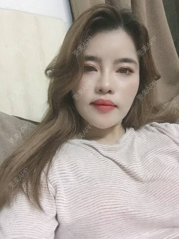 更美 - Edith 、Z的自体脂肪丰苹果肌经验 | 自体脂肪丰额头 | 自体脂肪丰面颊 | 自体脂肪丰太阳穴 | 自体脂肪丰苹果肌 | 福州 | 自体脂肪全面部填充