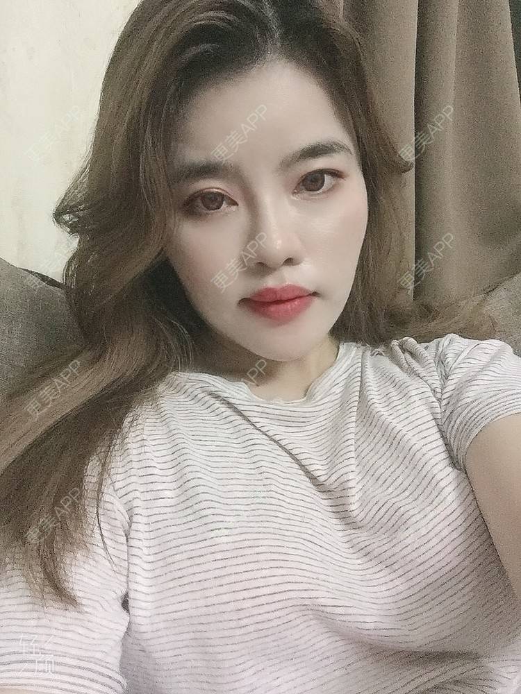 更美 - Edith 、Z的自体脂肪丰苹果肌经验 | 自体脂肪丰额头 | 自体脂肪丰面颊 | 自体脂肪丰太阳穴 | 自体脂肪丰苹果肌 | 福州 | 自体脂肪全面部填充