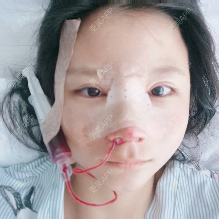 更美 - 更美用户GYLGovg47E的硅胶隆鼻经验 | 硅胶隆鼻 | 郑州