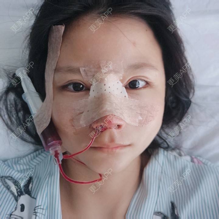 更美 - 更美用户GYLGovg47E的硅胶隆鼻经验 | 硅胶隆鼻 | 郑州