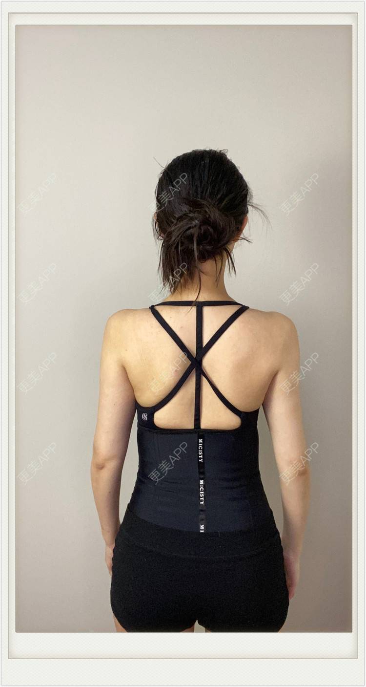 更美 - 不説感情事羌的吸脂经验 | 吸脂 | 无锡