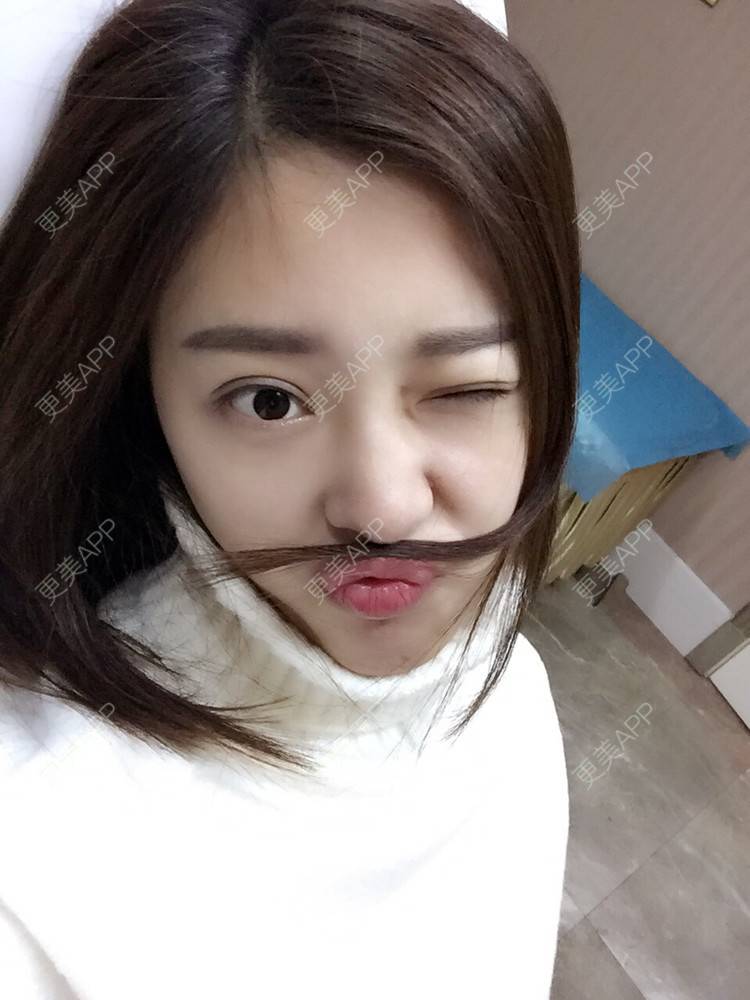 更美 - 更美用户Q7MwbEHUmr的胶原蛋白丰太阳穴经验 | 玻尿酸颈纹 | 玻尿酸额头 | 胶原蛋白丰太阳穴 | 深圳