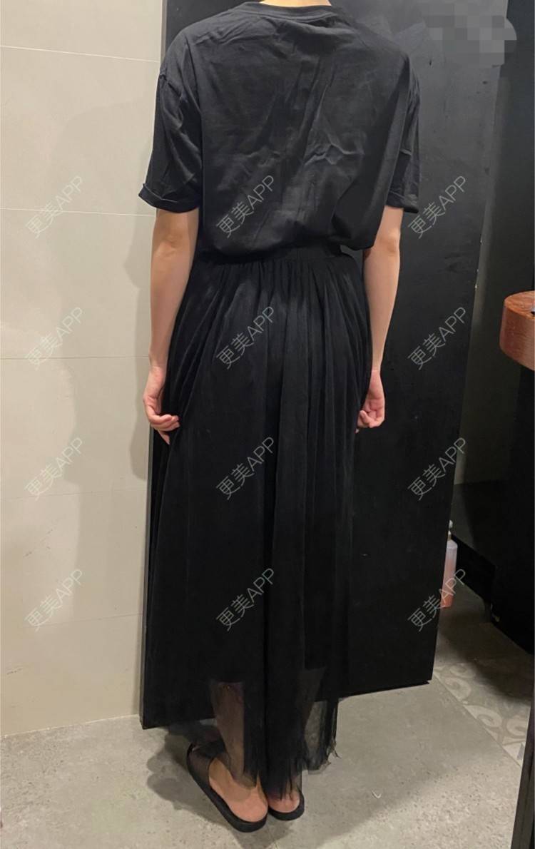 更美 - 玉琼#的自体脂肪丰臀经验 | 自体脂肪丰臀 | 上海