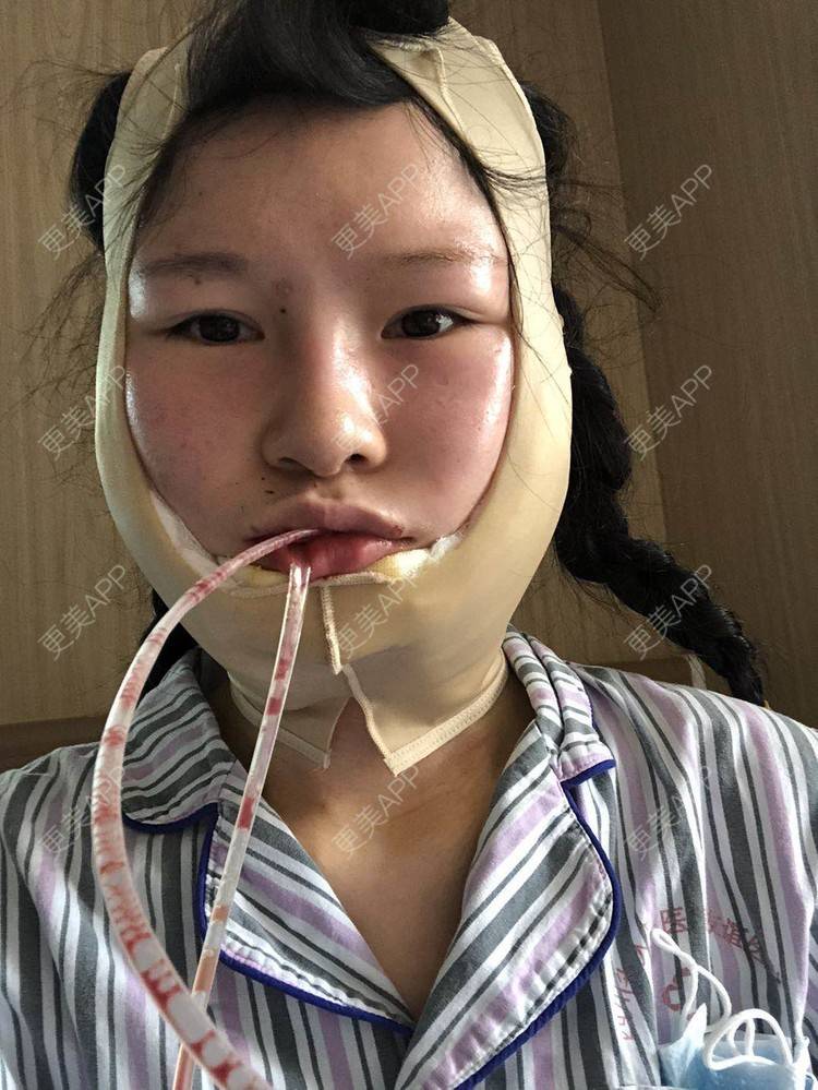 更美 - 更美用户1hOuWDVG0V的下颌角经验 | 成都 | 下颌角