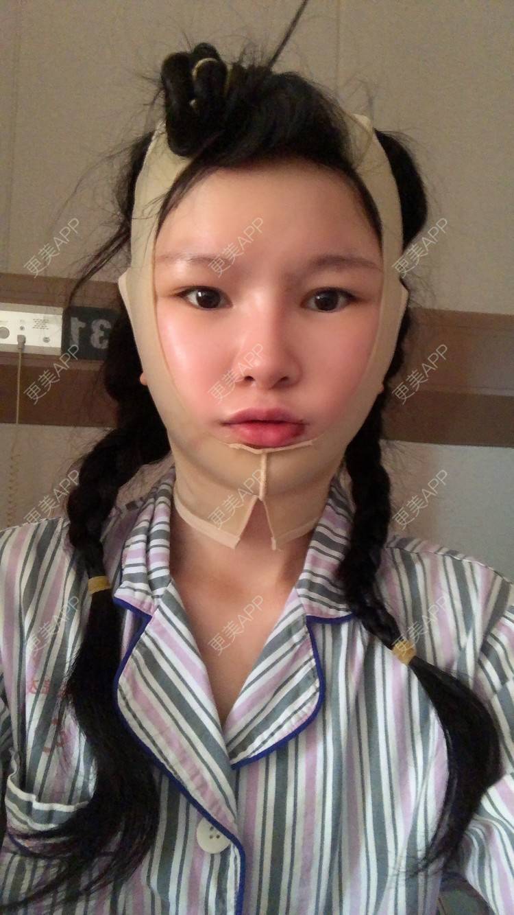 更美 - 更美用户1hOuWDVG0V的下颌角经验 | 成都 | 下颌角