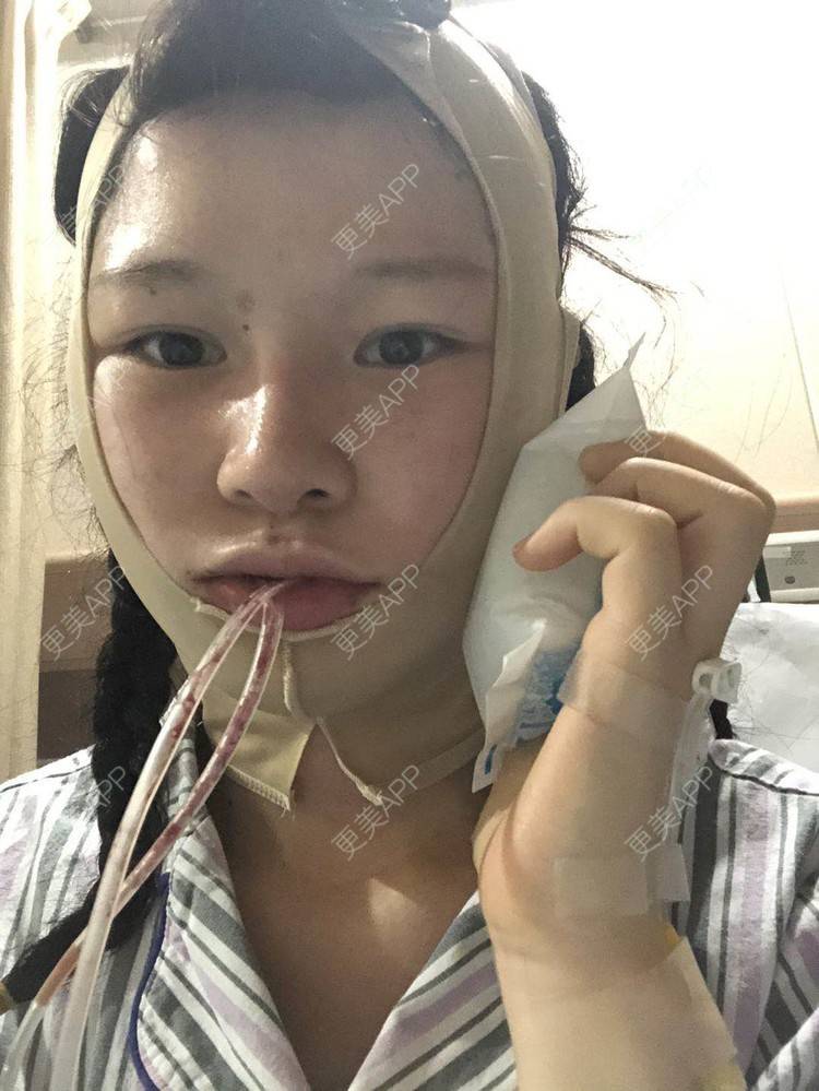 更美 - 更美用户1hOuWDVG0V的下颌角经验 | 成都 | 下颌角