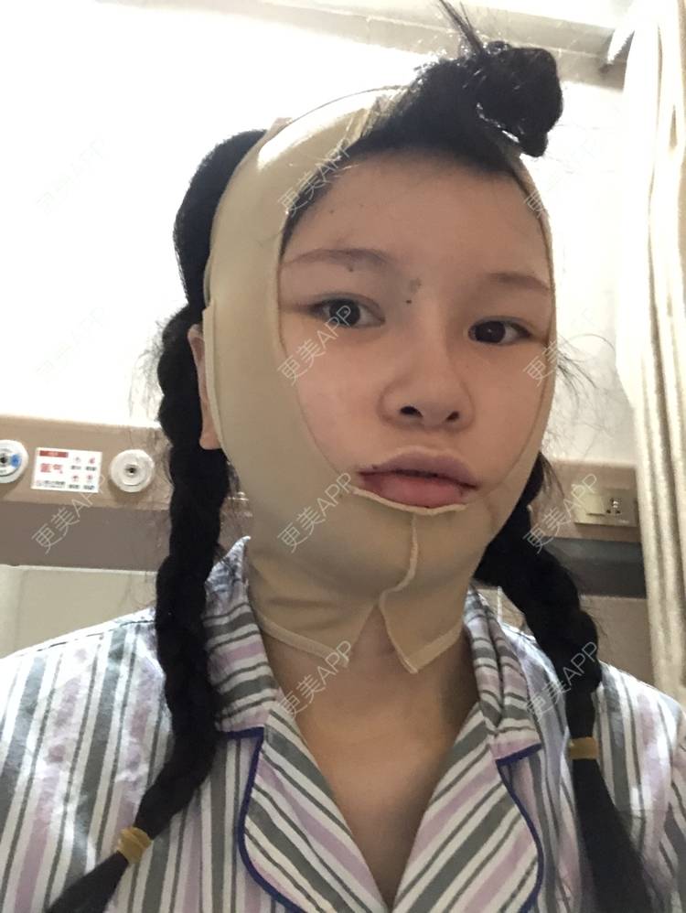 更美 - 更美用户1hOuWDVG0V的下颌角经验 | 成都 | 下颌角