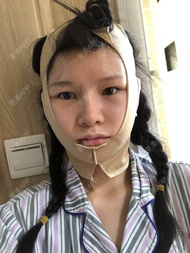 更美 - 更美用户1hOuWDVG0V的下颌角经验 | 成都 | 下颌角