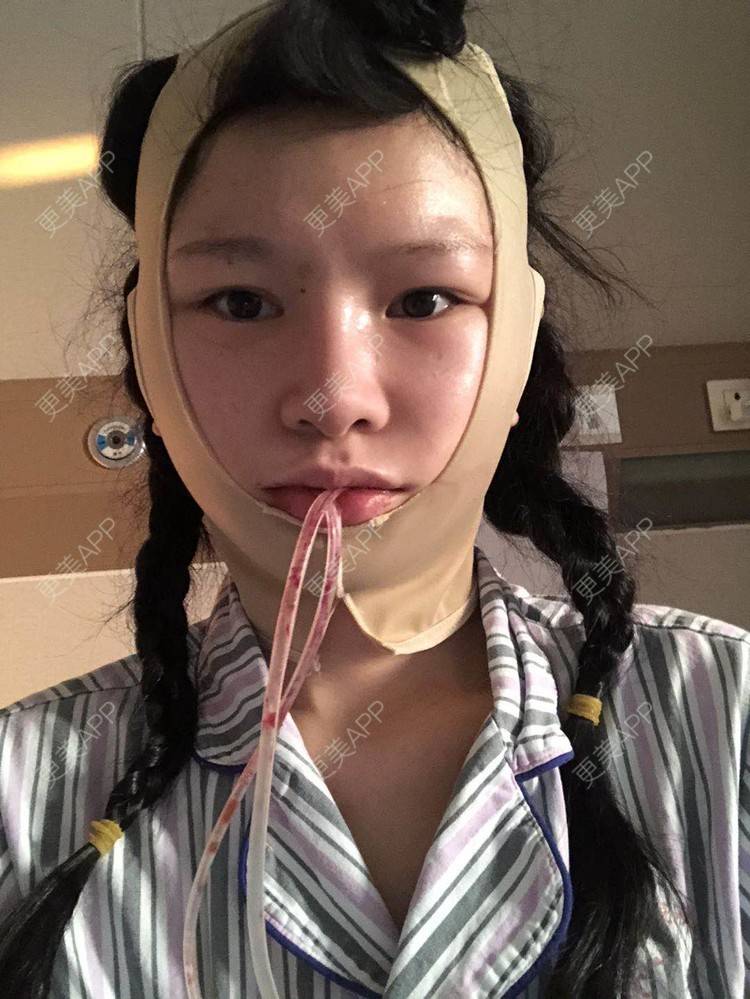 更美 - 更美用户1hOuWDVG0V的下颌角经验 | 成都 | 下颌角