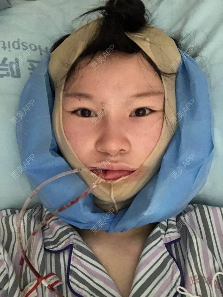 更美 - 更美用户1hOuWDVG0V的下颌角经验 | 成都 | 下颌角