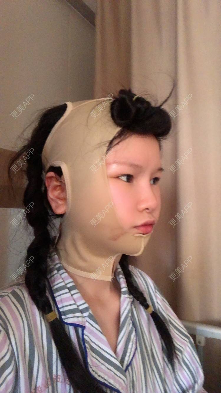更美 - 更美用户1hOuWDVG0V的下颌角经验 | 成都 | 下颌角