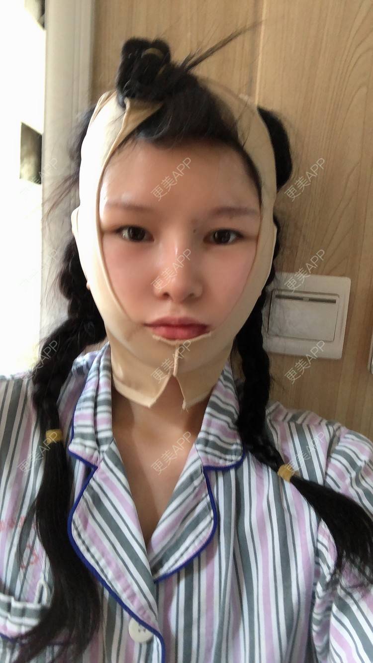 更美 - 更美用户1hOuWDVG0V的下颌角经验 | 成都 | 下颌角