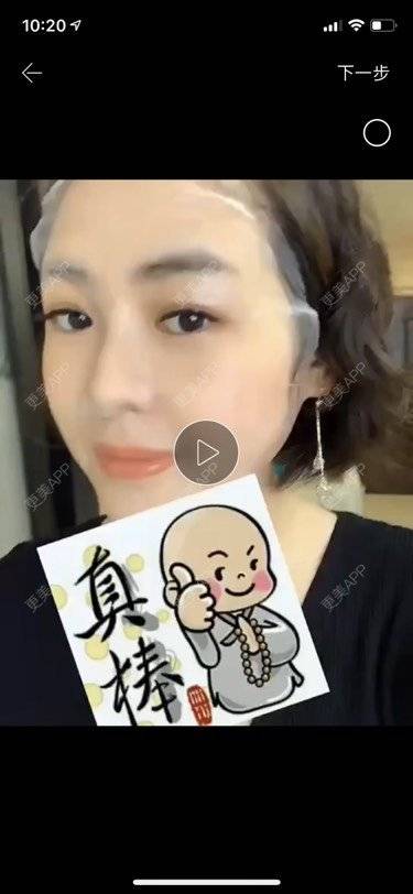 更美 - 小陀螺11的隆鼻经验 | 视频日记 | 隆鼻 | 赤峰