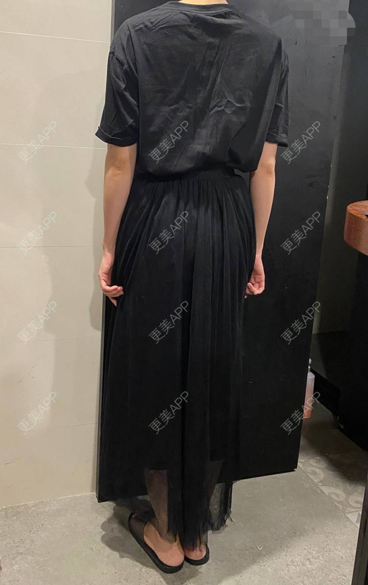 更美 - 玉琼#的自体脂肪丰臀经验 | 自体脂肪身体塑形 | 自体脂肪丰臀 | 上海